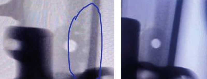 Röntgenbild des Gussteils vor (links) und nach der Optimierung des Schieber-Einlegeteils (rechts) 